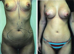 Body Procedures Patient Before & After Photo 1