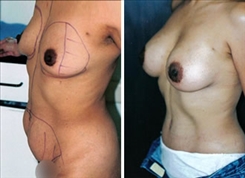 Body Procedures Patient Before & After Photo 1