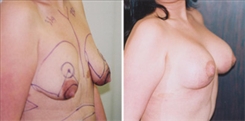 Combination Procedures & Body Sculpting Patient Before & After Photo 1