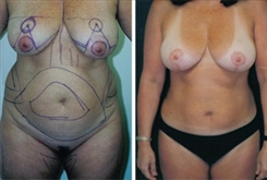 Body Procedures Patient Before & After Photo 1