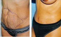 Body Procedures Patient Before & After Photo 1