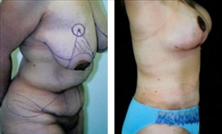 Body Procedures Patient Before & After Photo 1