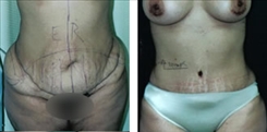 Combination Procedures & Body Sculpting Patient Before & After Photo 1