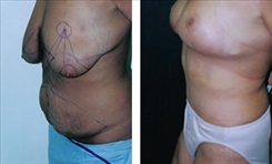 Combination Procedures & Body Sculpting Patient Before & After Photo 1