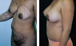 Body Procedures Patient Before & After Photo 1