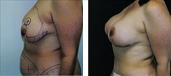 Combination Procedures & Body Sculpting Patient Before & After Photo 1