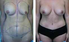 Body Procedures Patient Before & After Photo 1