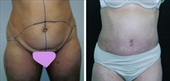 Combination Procedures & Body Sculpting Patient Before & After Photo 1