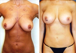 Combination Procedures & Body Sculpting Patient Before & After Photo 1