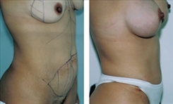 Body Procedures Patient Before & After Photo 1