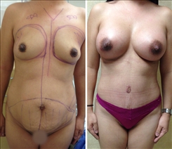 Body Procedures Patient Before & After Photo 1