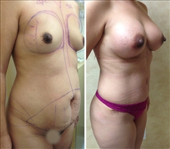 Combination Procedures & Body Sculpting Patient Before & After Photo 1