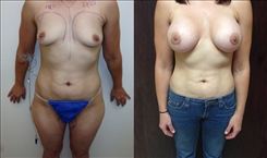 Combination Procedures & Body Sculpting Patient Before & After Photo 1