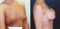 Body Procedures Patient Before & After Photo 1