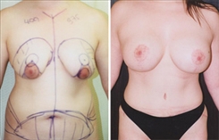 Body Procedures Patient Before & After Photo 1