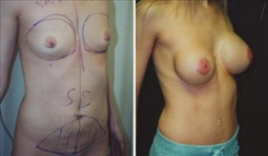 Body Procedures Patient Before & After Photo 1