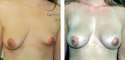 Breast Asymmetry Patient Before & After Photo 1