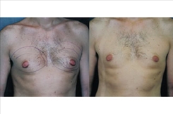 Procedures for Men Patient Before & After Photo 1