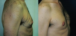 Gynecomastia Patient Before & After Photo 1