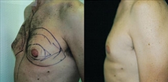 Gynecomastia Patient Before & After Photo 1