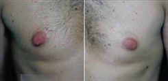 Procedures for Men Patient Before & After Photo 1