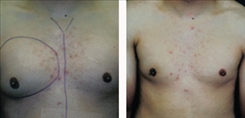 Gynecomastia Patient Before & After Photo 1