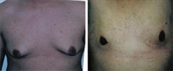 Gynecomastia Patient Before & After Photo 1