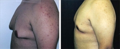 Gynecomastia Patient Before & After Photo 1