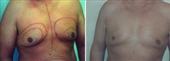 Gynecomastia Patient Before & After Photo 1