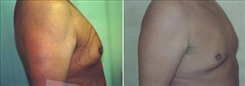 Gynecomastia Patient Before & After Photo 1