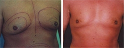 Gynecomastia Patient Before & After Photo 1