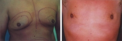 Gynecomastia Patient Before & After Photo 1