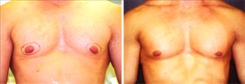 Gynecomastia Patient Before & After Photo 1