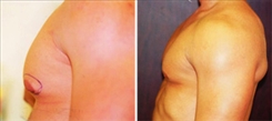 Gynecomastia Patient Before & After Photo 1