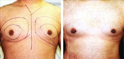 Gynecomastia Patient Before & After Photo 1