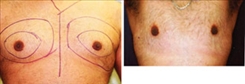 Gynecomastia Patient Before & After Photo 1