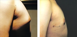 Gynecomastia Patient Before & After Photo 1