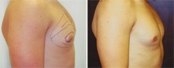 Gynecomastia Patient Before & After Photo 1