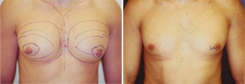 Gynecomastia Patient Before & After Photo 1