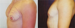 Gynecomastia Patient Before & After Photo 1