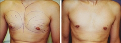 Gynecomastia Patient Before & After Photo 1