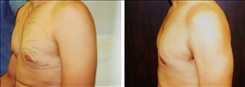 Gynecomastia Patient Before & After Photo 1