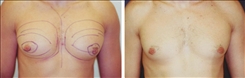 Gynecomastia Patient Before & After Photo 1