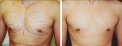 Gynecomastia Patient Before & After Photo 1