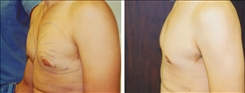 Gynecomastia Patient Before & After Photo 1