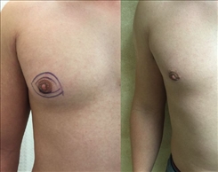 Gynecomastia Patient Before & After Photo 1