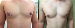 Gynecomastia Patient Before & After Photo 1