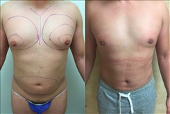 Procedures for Men Patient Before & After Photo 1