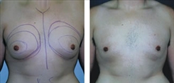 Gynecomastia Patient Before & After Photo 1