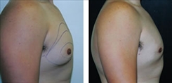 Gynecomastia Patient Before & After Photo 1